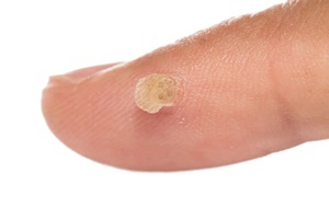 The wart is a skin disease that can effectively fight Skincell Pro